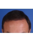 After Hair Transplant&nbsp;Front